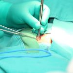 Umbilical Hernia Surgery