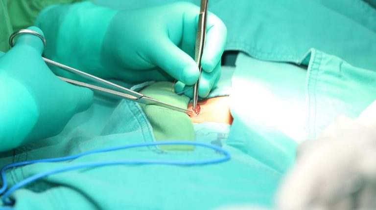 Umbilical Hernia Surgery